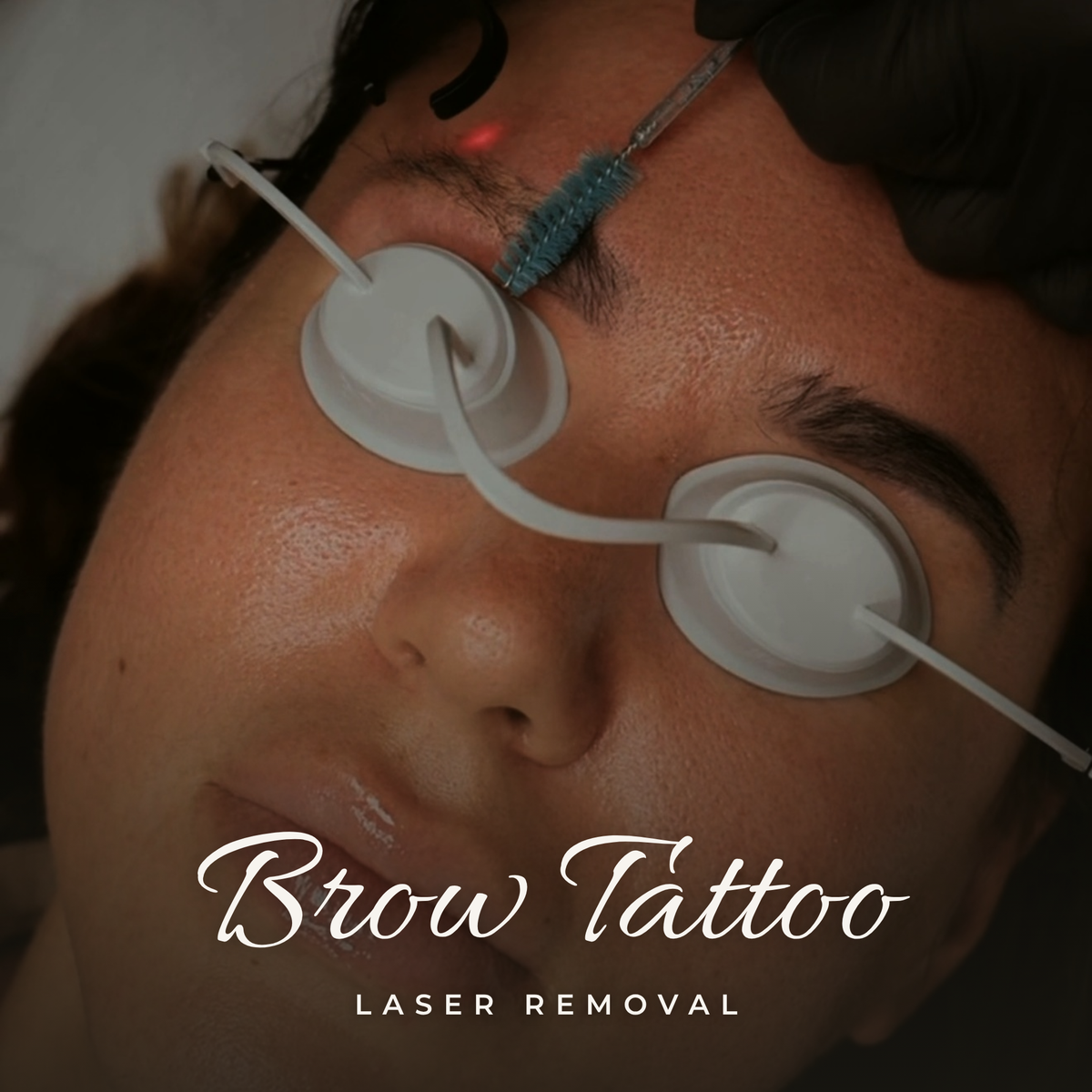 Laser Brow Tattoo Removal — Consultation