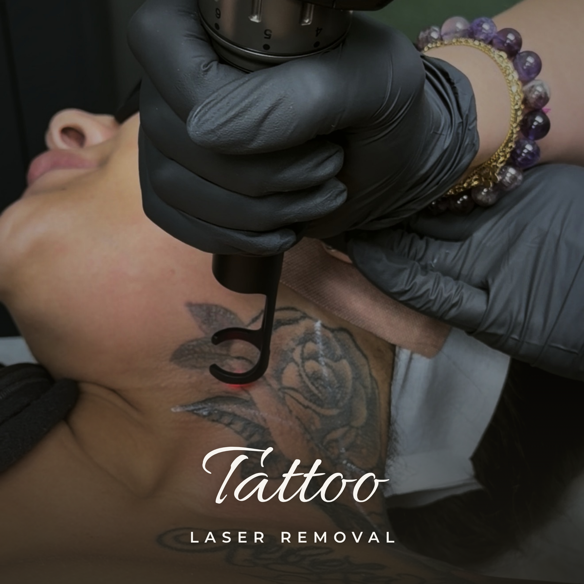 Laser Tattoo Removal — Consultation